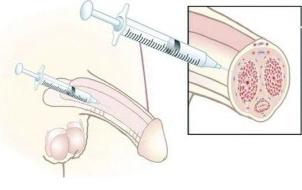 Injection of hyaluronic acid to enlarge the penis
